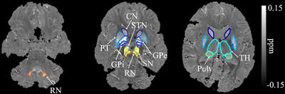 Quantitative susceptibility mapping of basal ganglia iron is associated with cognitive and motor functions that distinguish spinocerebellar ataxia type 6 and type 3